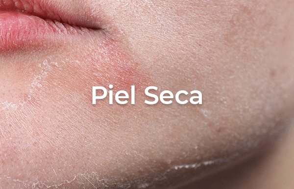 Piel Seca