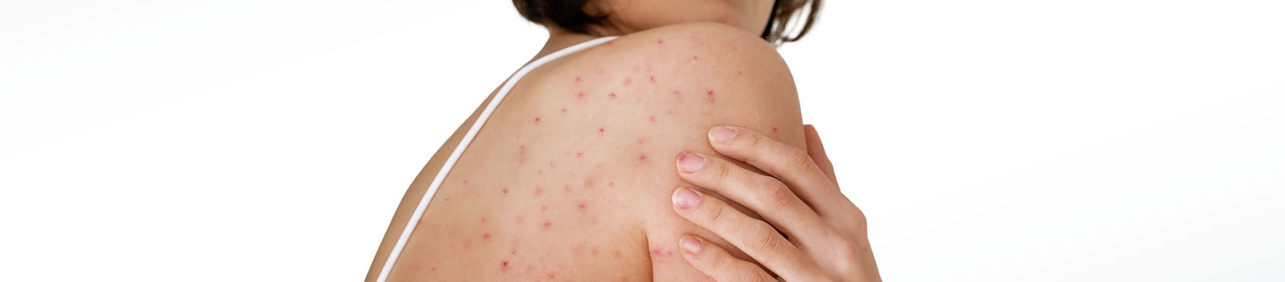 mujer cuidando su piel para evitar queratosis pilaris