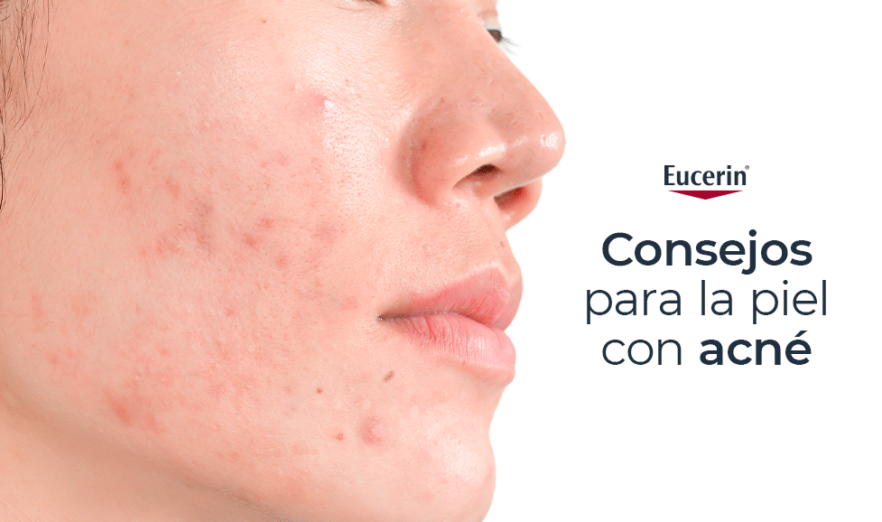 Consejos para la piel con acné