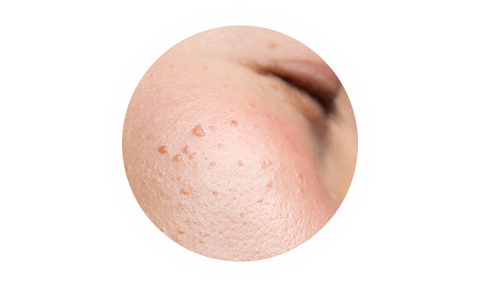 Cara con imperfecciones