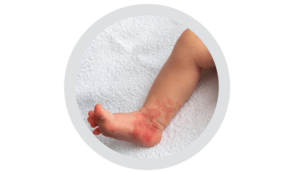 ¿Qué es un hemangioma infantil?
