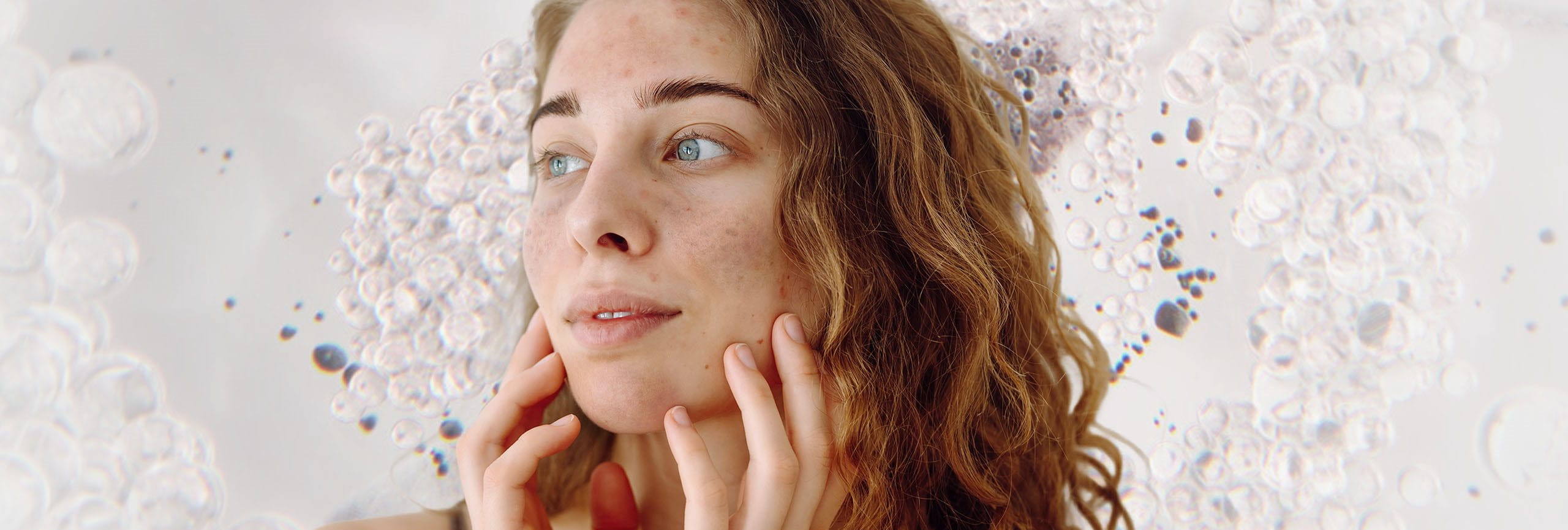 Prevenir la hiperpigmentación facial