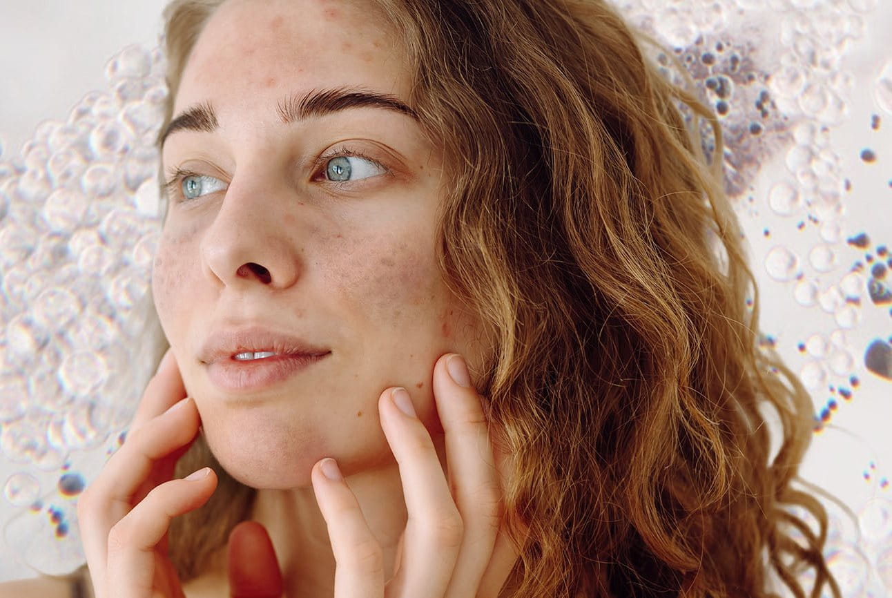 Prevenir la hiperpigmentación facial