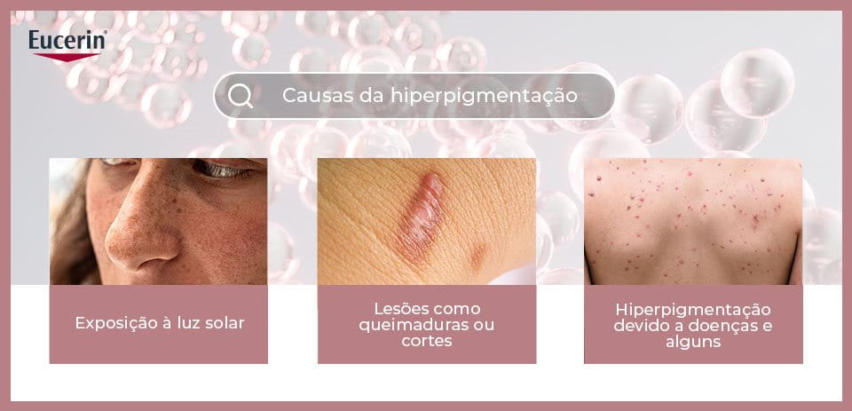 Causas da hiperpigmentação