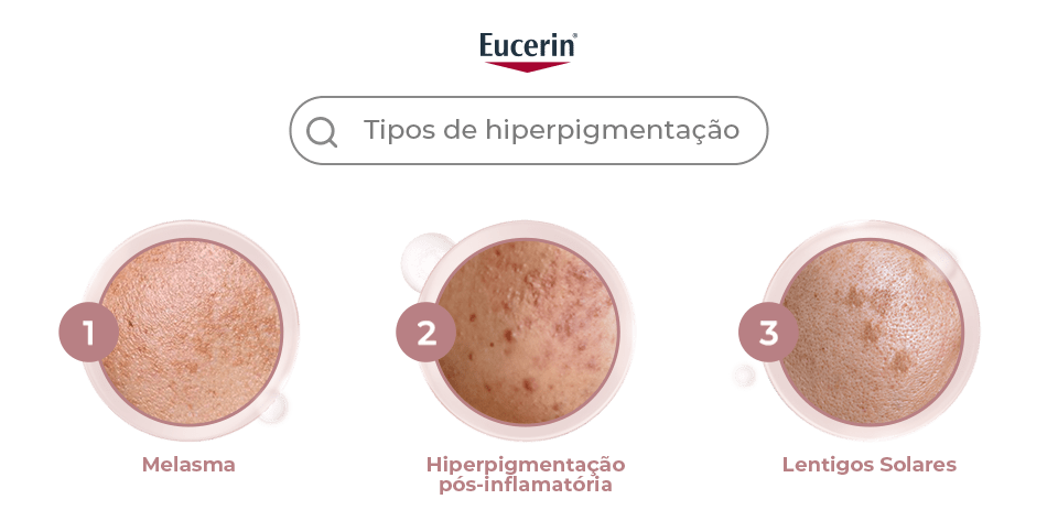 Prevenir la hiperpigmentación