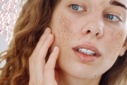 Hiperpigmentación de la piel