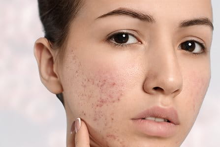 Acne e hiperpigmentação da pele