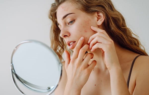 mulher com acne na tpm