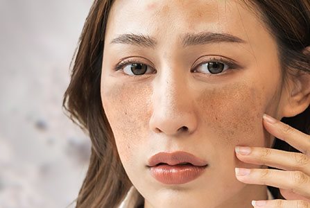 Hiperpigmentação causada pelo melasma