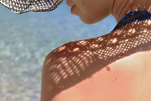 Eine junge Frau mit Muttermalen auf dem Rücken sitzt mit dem Gesicht zum Meer und hat einen Sonnenhut zum Schutz auf.
