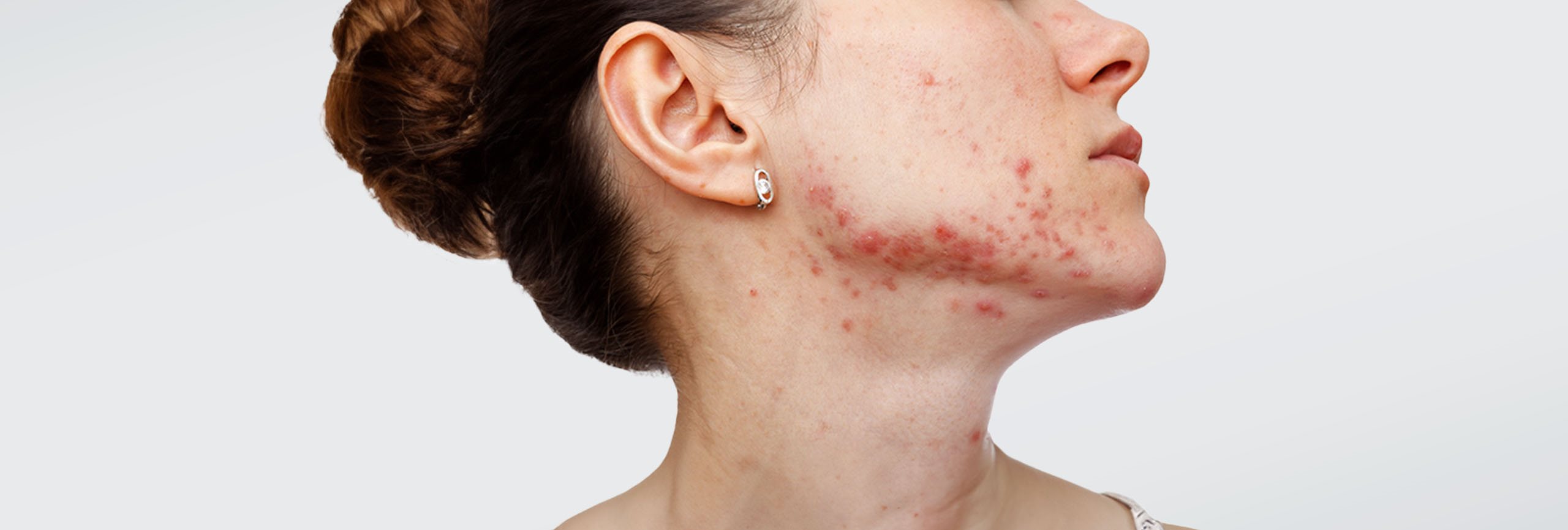 características del acné por estrés 