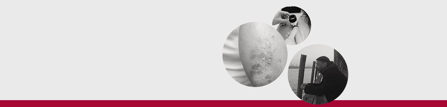 Stigma bei Psoriasis – gemeinsam dagegen 