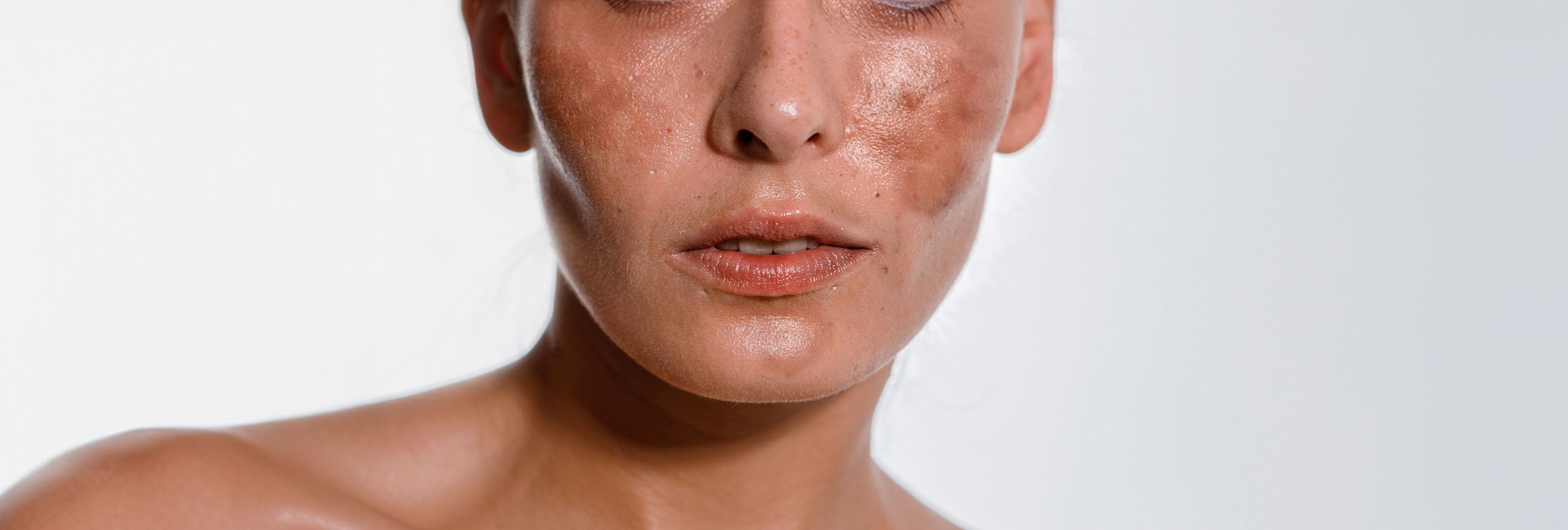 causas de las manchas por melasma