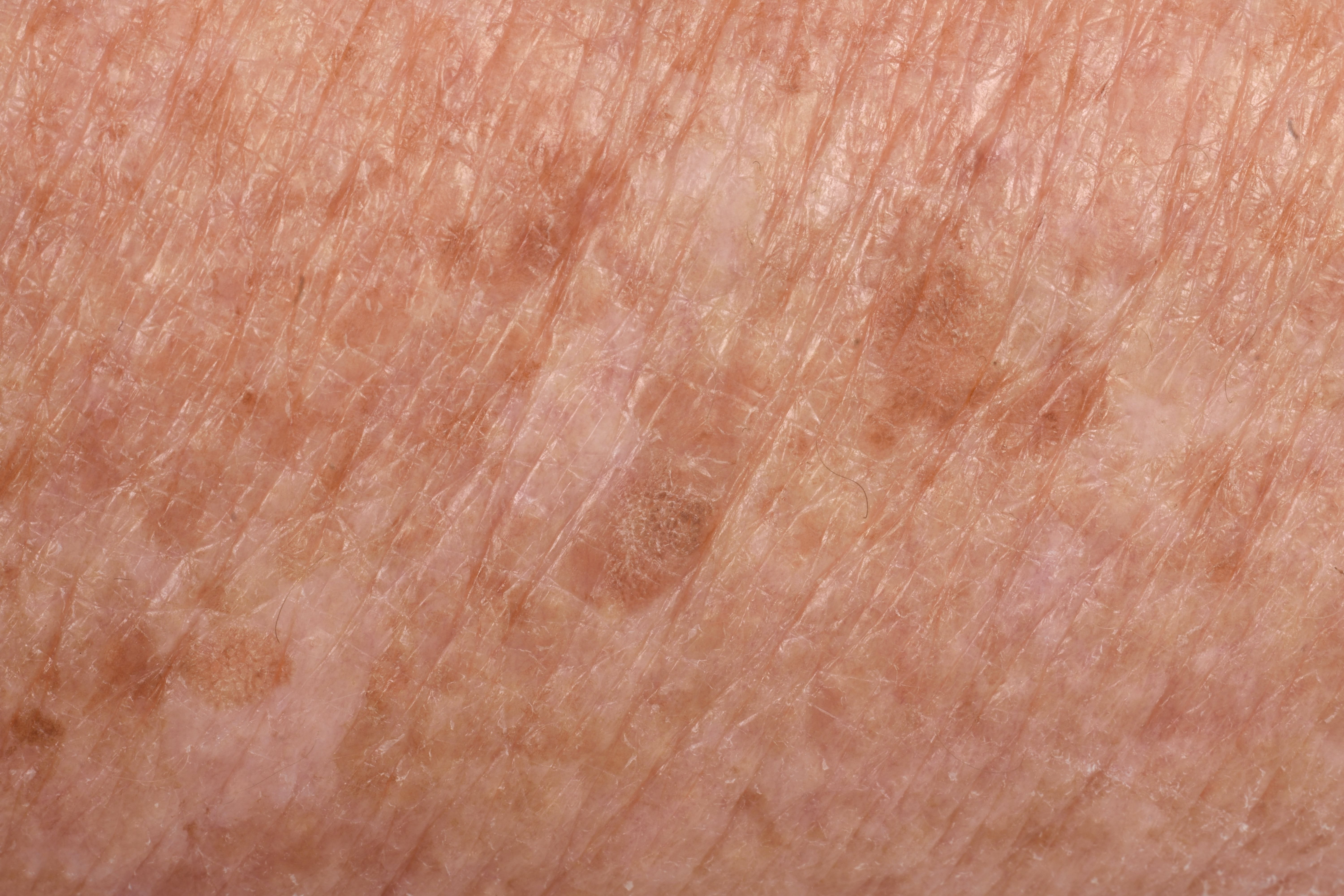 lentigos-manchas-en-la-piel-eucerin