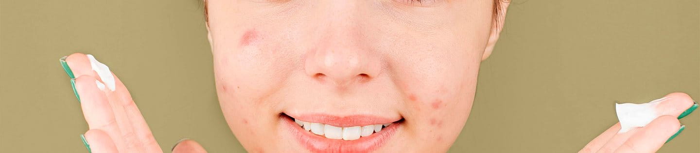acne-factores-contribuyentes -tratamientos-soluciones