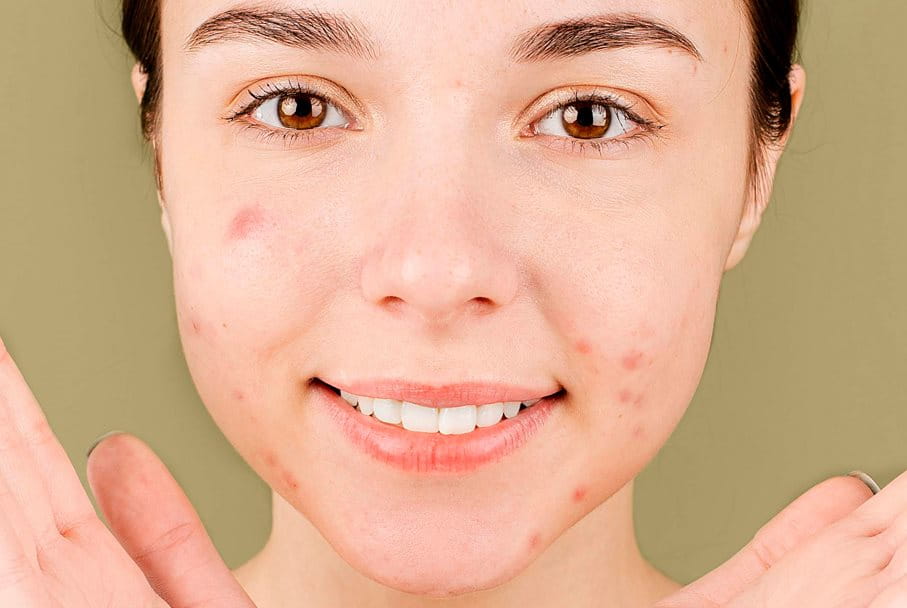 acne-factores-contribuyentes -tratamientos-soluciones