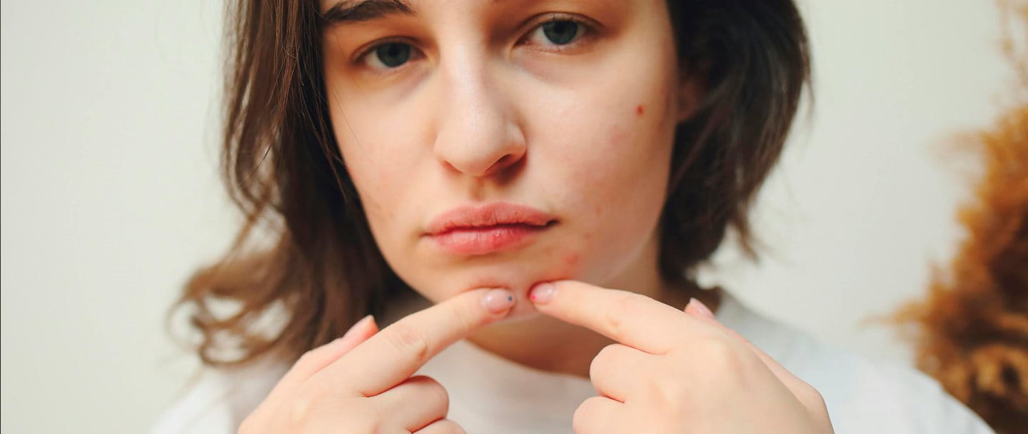 En la formación de los puntos negros, de las espinillas y de los granos intervienen muchos factores complejos