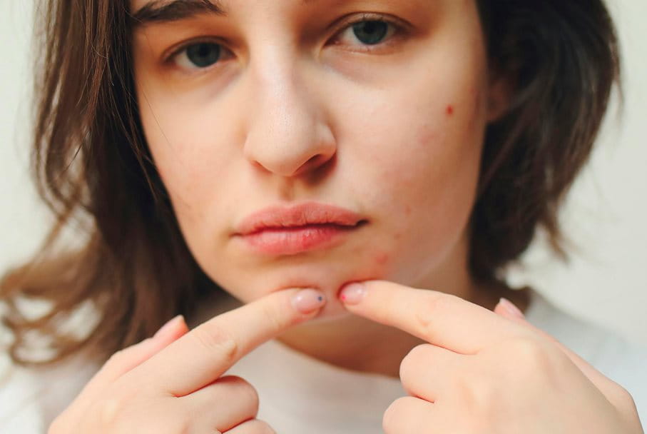 En la formación de los puntos negros, de las espinillas y de los granos intervienen muchos factores complejos