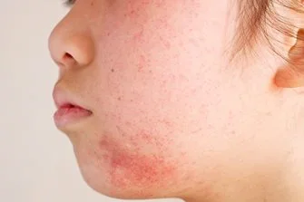 Dermatitis perioral: qué es, causas y tratamiento | Eucerin