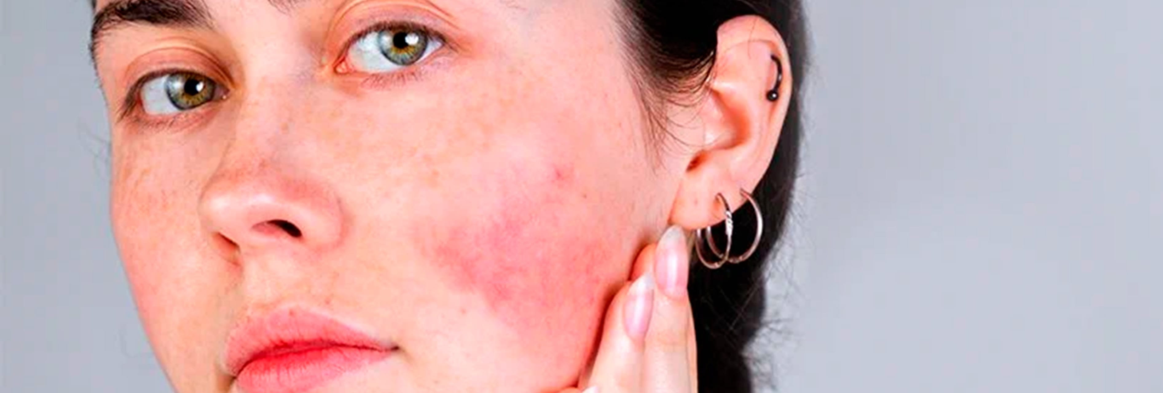 Marcas Rojas Manchas rojas en la piel: causas y remedios | Eucerin