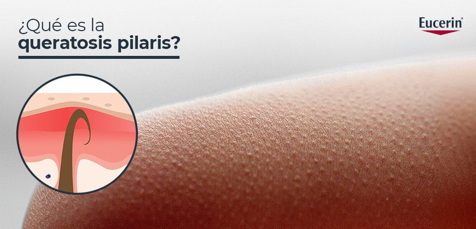 Queratosis pilaris
