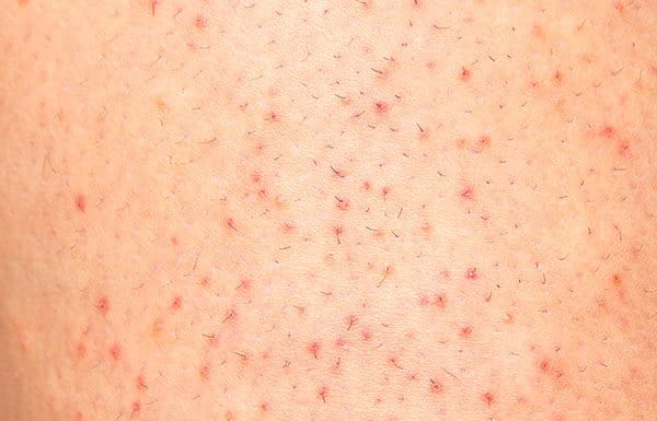 queratosis pilaris