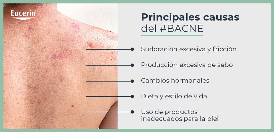Causas de bacne