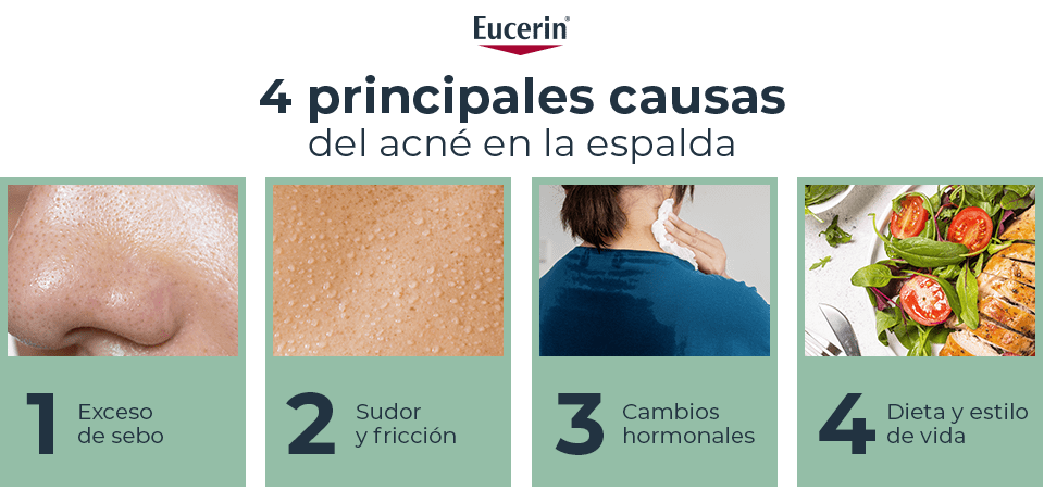 Causas del acné en la espalda
