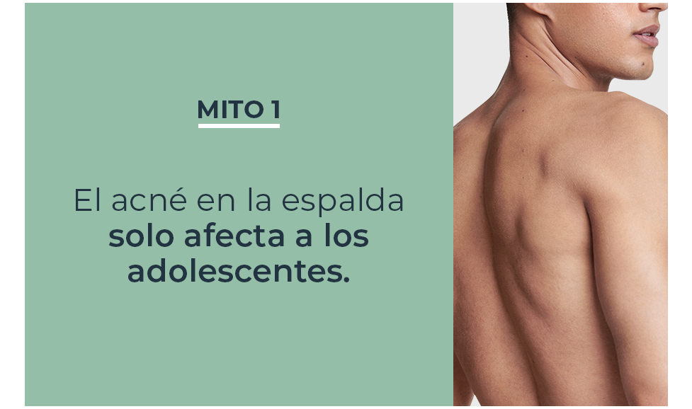 Mitos y verdades sobre acné en la espalda