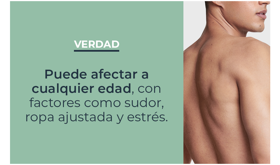 Mitos y verdades sobre acné en la espalda