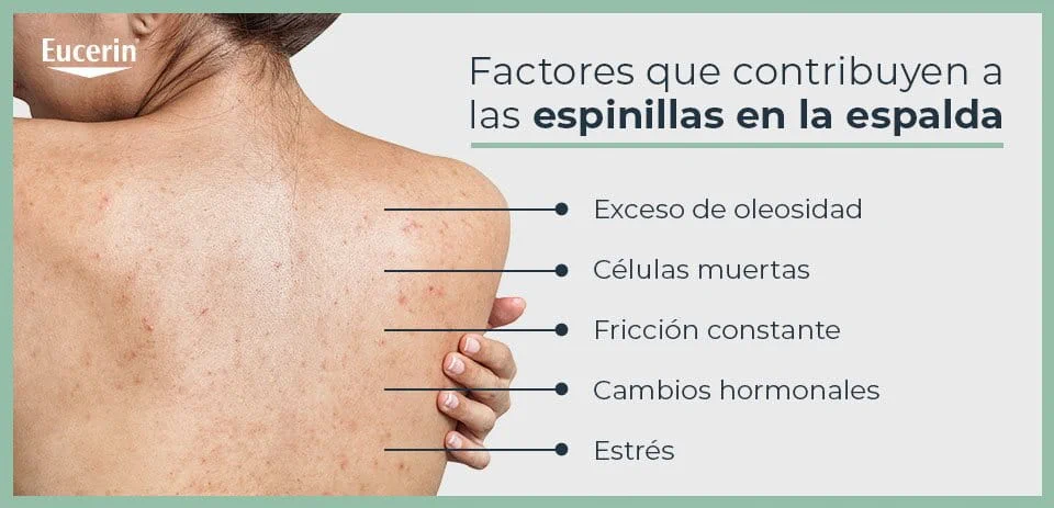 Factores de las espinillas en la espalda