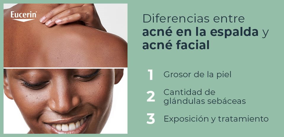 Acné en la espalda y acné facial