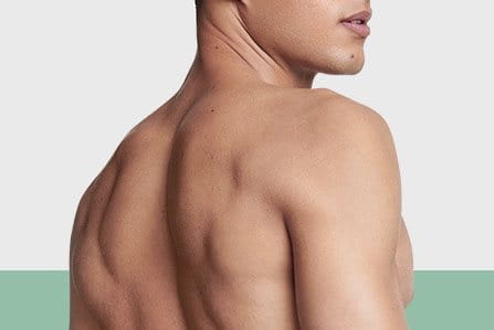 Espinillas en la espalda