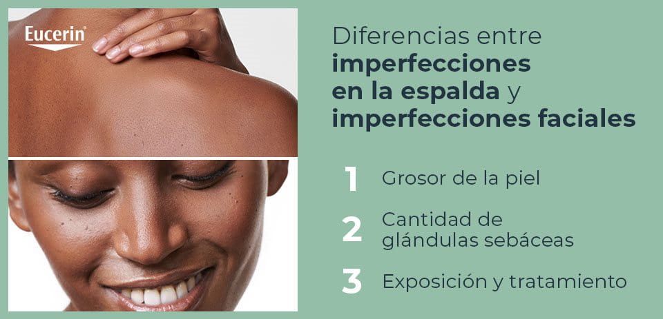 Imperfecciones en la espalda y imperfecciones faciales