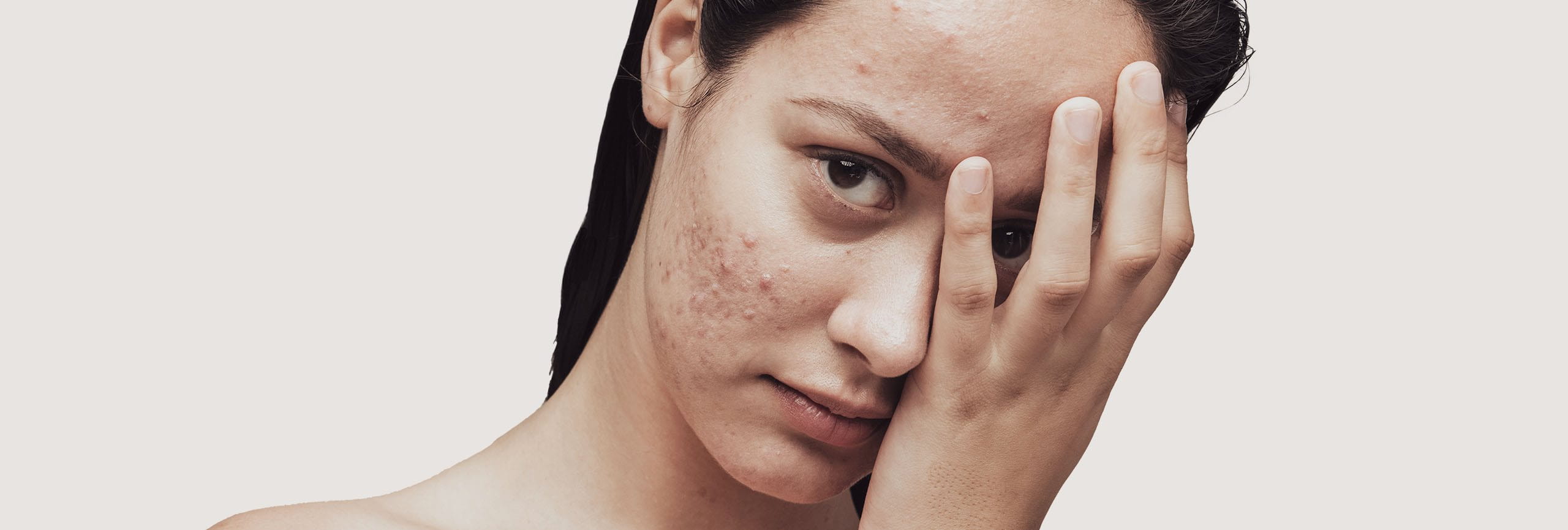 Chica adulta con acné en la cara