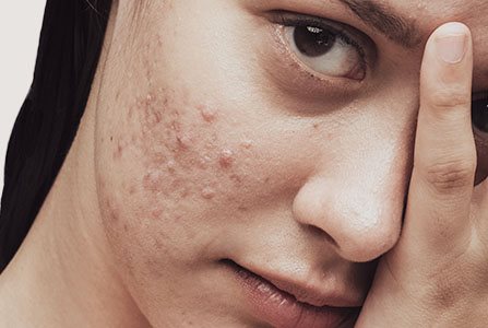 Chica adulta con imperfecciones en la cara