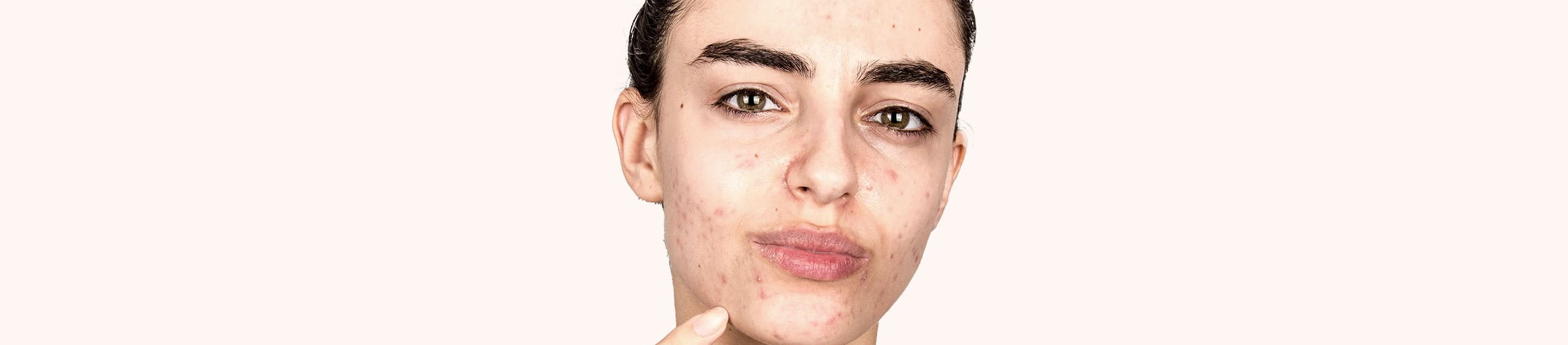 Persona con acné en el rostro