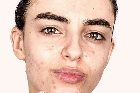 Persona con acné en el rostro