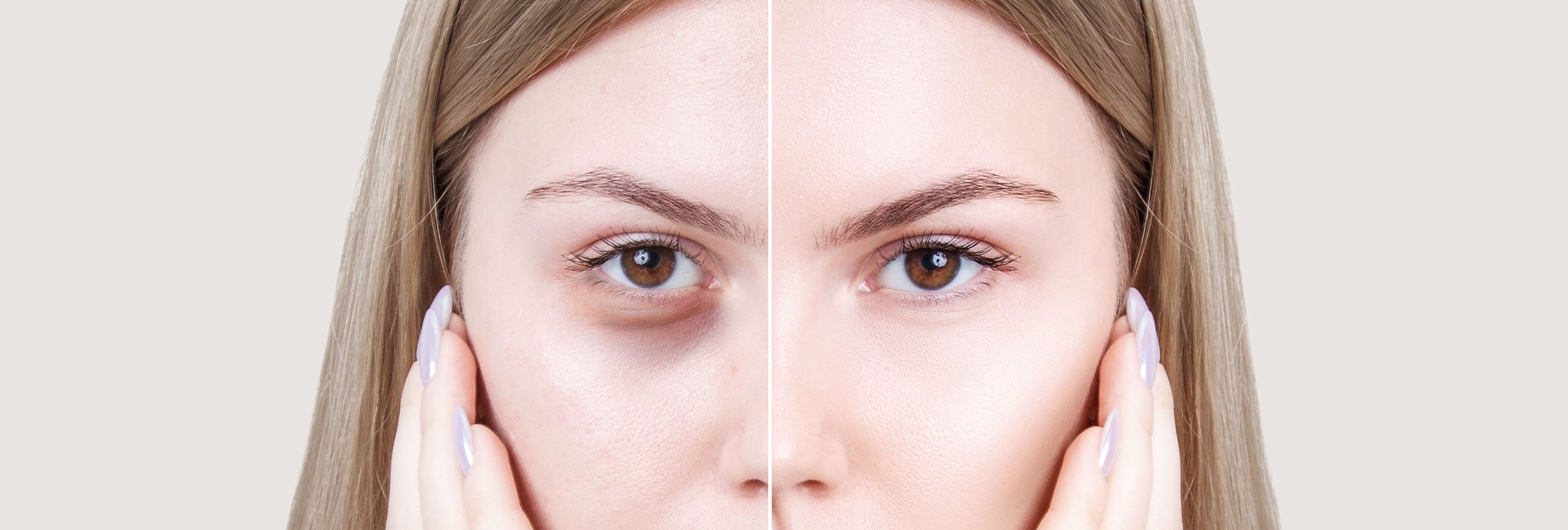 Mujer con ojeras y bolsas en los ojos