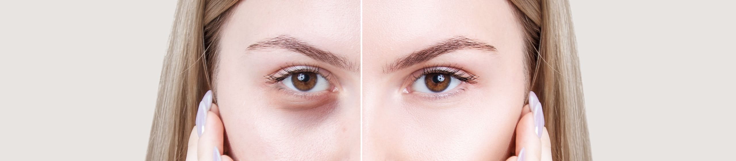 Mujer con ojeras y bolsas en los ojos