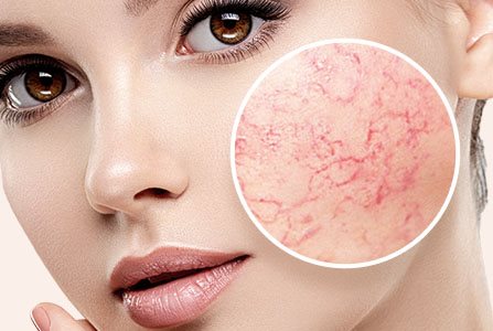 Chica con la piel del rostro sensible