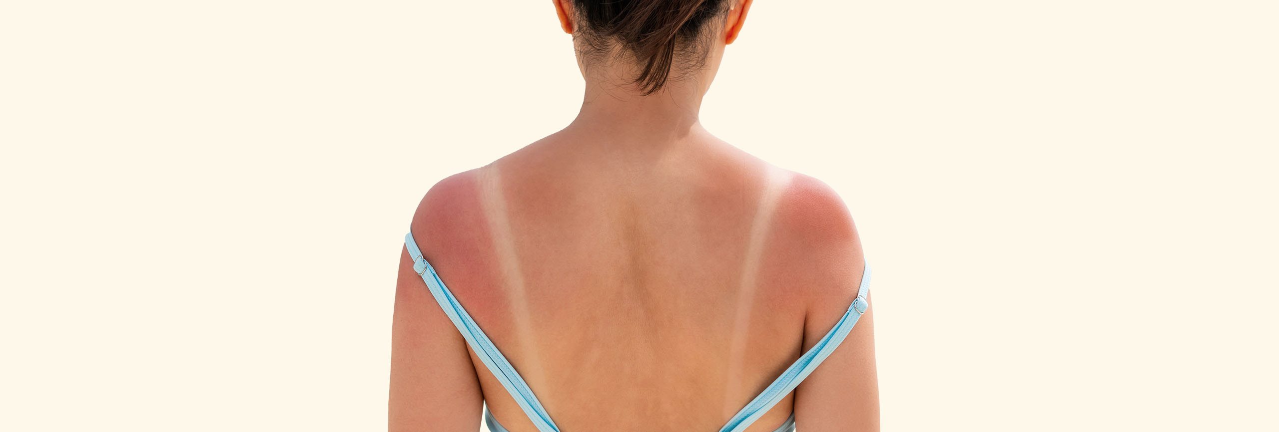 Persona afectada por el sol