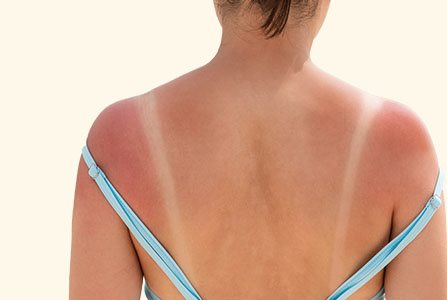 Persona afectada por el sol