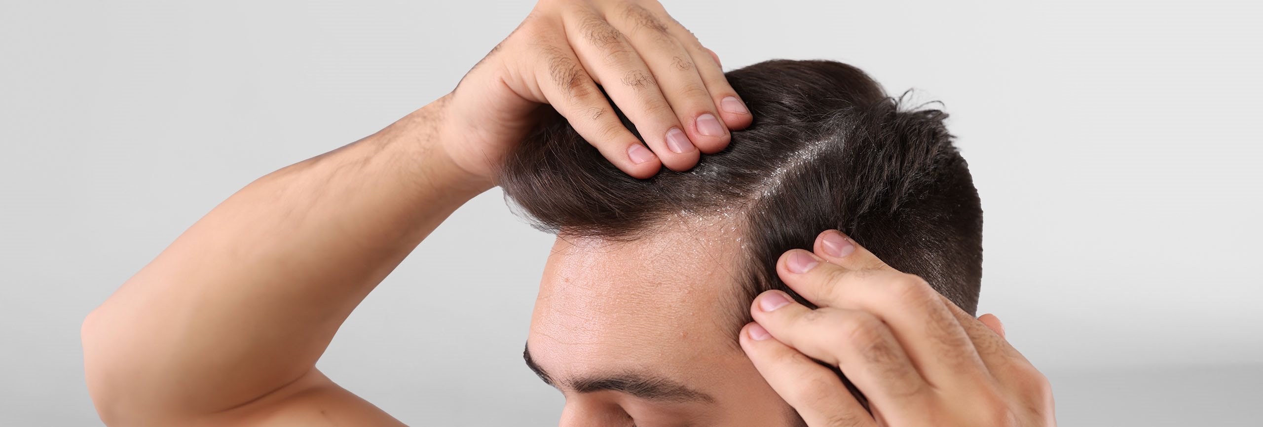 Persona con dermatitis seborreica