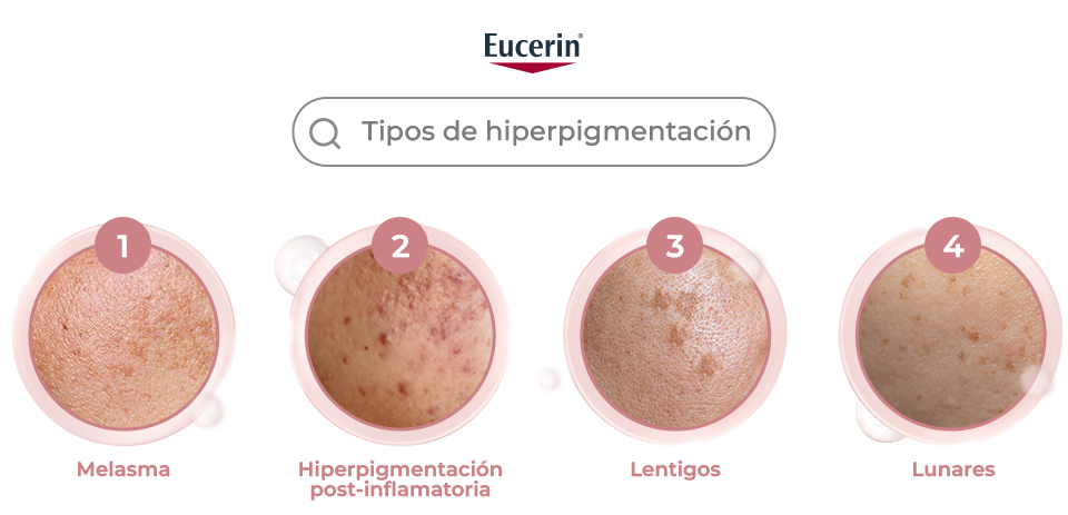 Tipos de hiperpigmentación