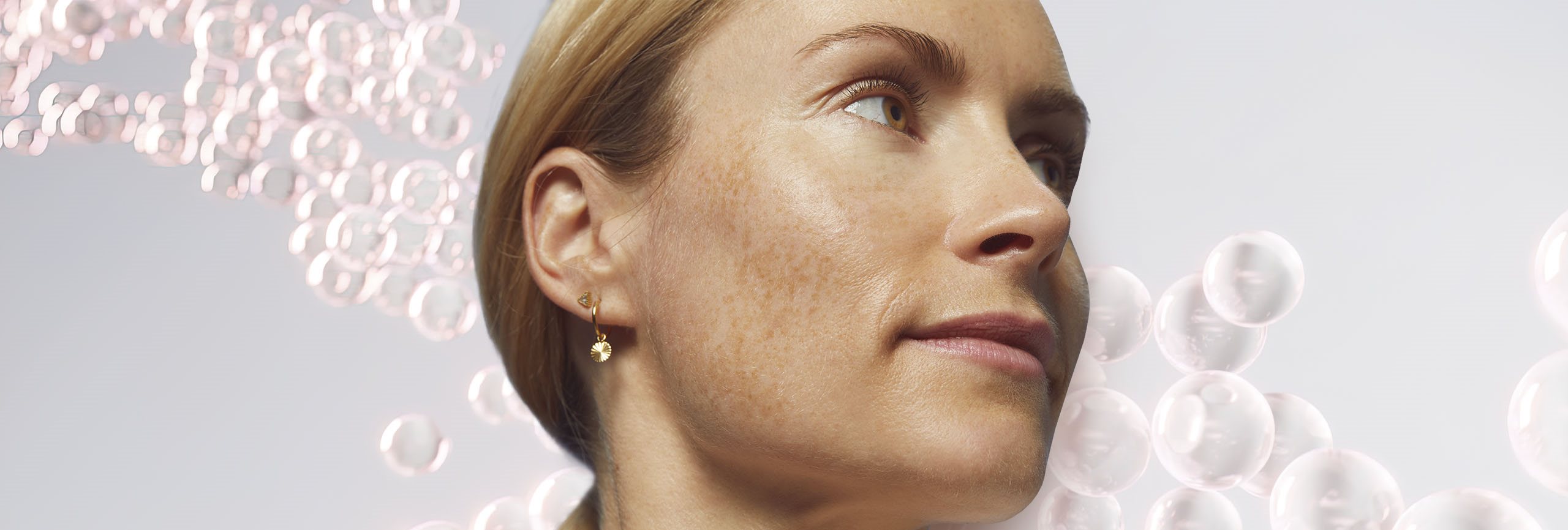 Hiperpigmentación de la piel