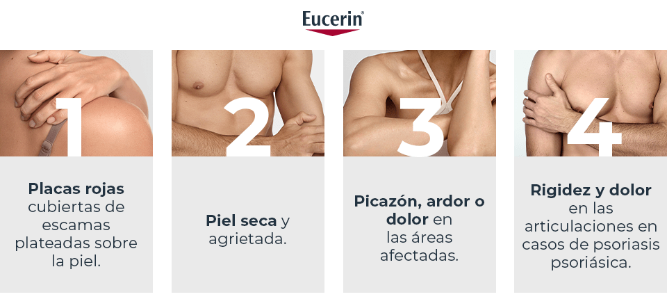 Síntomas de la psoriasis