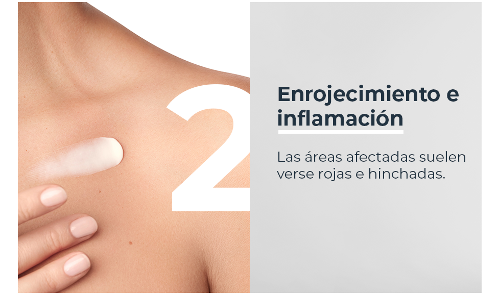 Enrojecimiento e inflamación