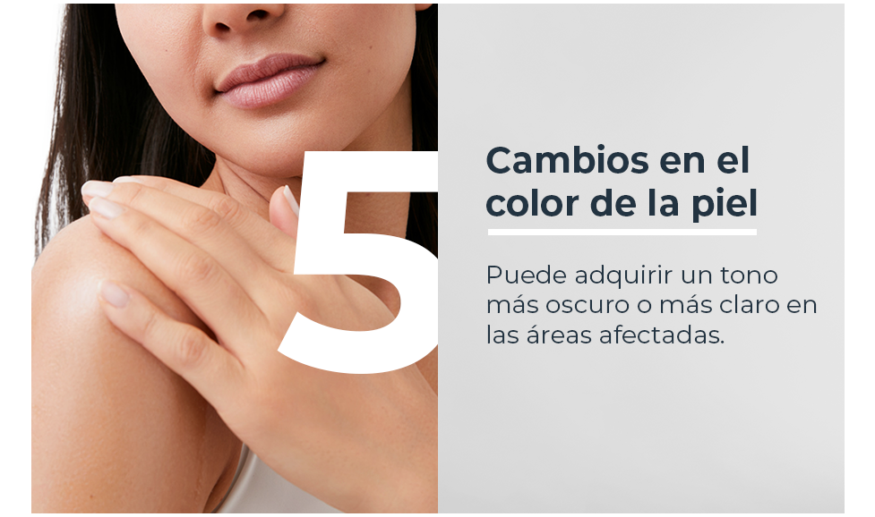 Cambios en el color de la piel