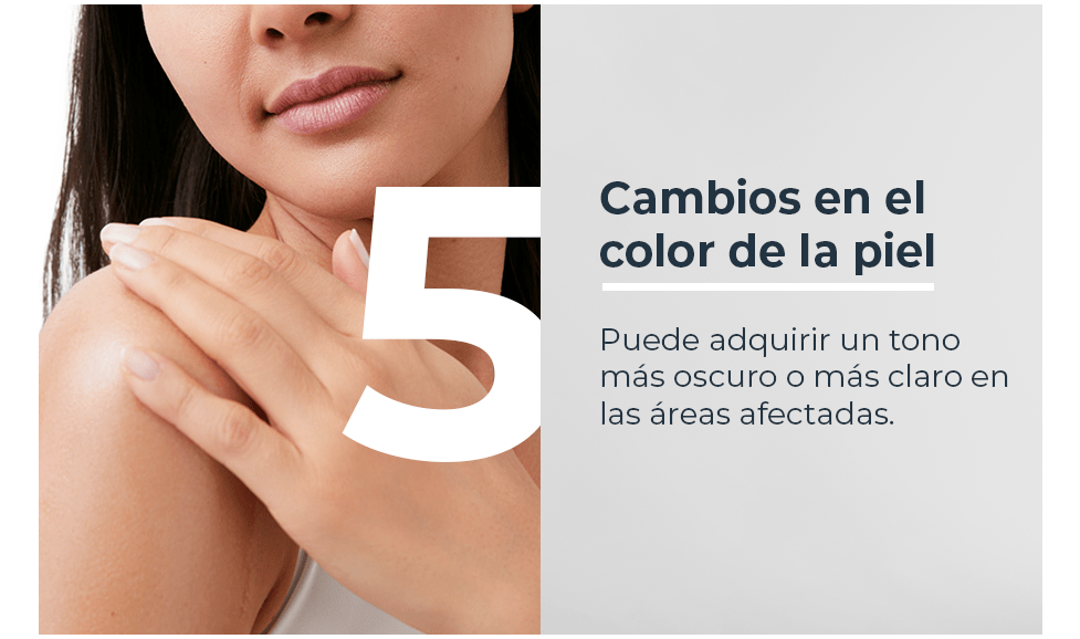 Cambios en el color de la piel